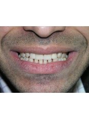 Veneers - Dental Care Egypt