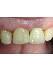 Dental Implants - Dental Care Egypt