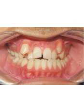 Braces - Dental Care Egypt