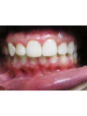 Gum Surgery - Dental Care Egypt