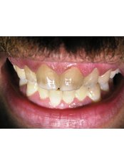 Teeth Whitening - Dental Care Egypt