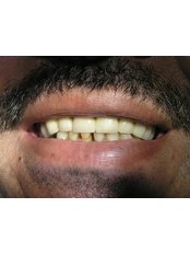 Dental Crowns - Dental Care Egypt