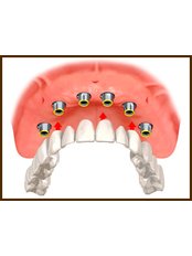 Implant Bridge - Dental Experts Clinic