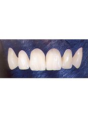 Porcelain Veneers - Dental Experts Clinic