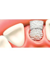 Bone Graft  - Dental Experts Clinic