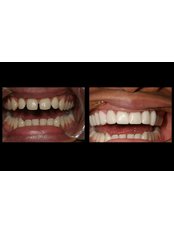 PFM Bridge - Dental Experts Clinic