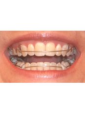 Orthodontic Retainer - Dental Experts Clinic