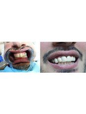 Zirconia Crown - Dental House