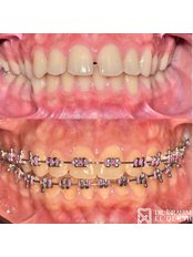 Orthodontics - Dr Ibrahim El Qersh Dental Clinic