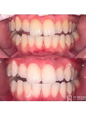 Teeth Whitening - Dr Ibrahim El Qersh Dental Clinic