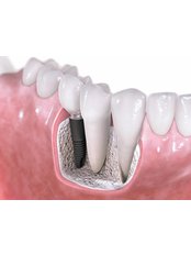 Restoration of Implants - Dr.Tamer Z. Thabet Dental Clinic