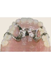 Removable Partial Dentures - Dr.Tamer Z. Thabet Dental Clinic