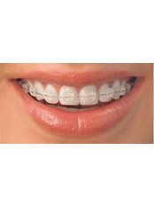 Clear Braces - Dr.Tamer Z. Thabet Dental Clinic