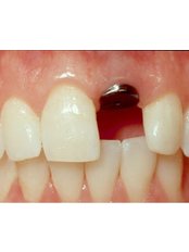 Single Implant - Dr.Tamer Z. Thabet Dental Clinic