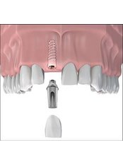 Dental Implants - Elite Dental and Medical Center - Maadi