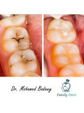 Dental Sealant - Family Dent Clinic