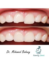 Chipped Tooth Repair - Family Dent Clinic