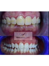 Teeth Whitening - Helio Dental Clinic - New Cairo