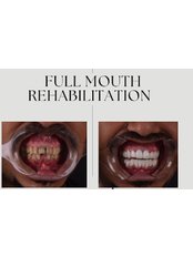 Full Mouth Rehabilitation - Helio Dental Clinic - New Cairo