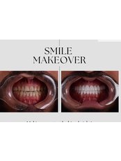 Smile Makeover - Helio Dental Clinic - New Cairo