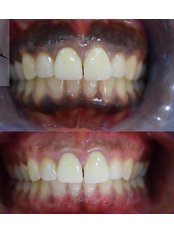 Gum Depigmentation - Helio-Dental Clinic