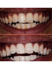 Teeth Whitening - Omar Essam Implantology Clinic