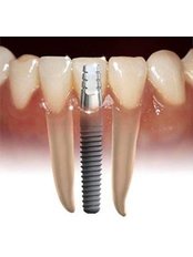 Dental Implants - Sheraton Dental Clinic