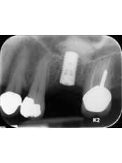 Dental Implants - The White Smile Clinic
