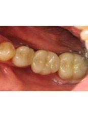 Dental Bridges - The White Smile Clinic