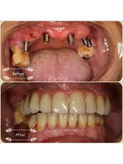 Dental Implants - ToothMate Dental Clinic