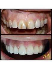 Veneers - ToothMate Dental Clinic
