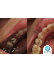 Fillings - ToothMate Dental Clinic