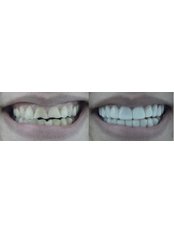Snap-On Smile™ - White Pearl Dental Clinic