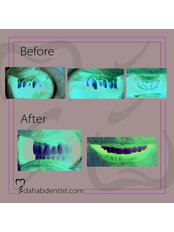 Dental Implants - Dr. Adel Ramadan Dental Clinic