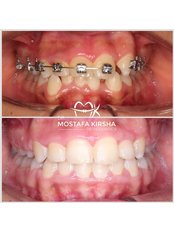 Orthodontics - Dr Omar Farouk's Dental Clinic Dahab