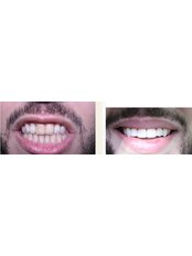 Veneers - Al Eyada Dental Clinic