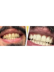 Teeth Whitening - Al Eyada Dental Clinic