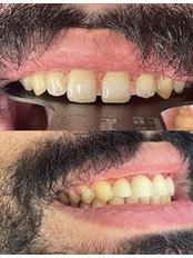 Fillings - Al Eyada Dental Clinic