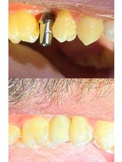 Dental Implants - Al Eyada Dental Clinic