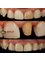 Berlin Dental Center - restoring single dark tooth to natural  