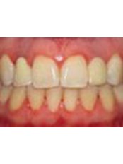 Immediate Implant Placement - Golf Dental Care
