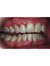 Teeth Cleaning - Golf Dental Care