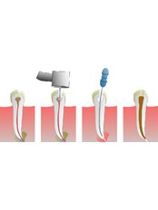 Root canals - Golf Dental Care