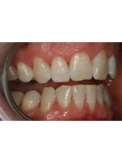 Teeth Cleaning - Golf Dental Care