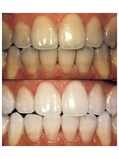 Teeth Whitening - Golf Dental Care
