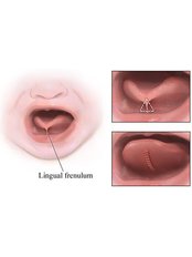 Lingual Frenectomy - Golf Dental Care