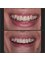 Dr. Moustafa Nashat - Chipped Tooth Repair 