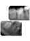 Dr. Moustafa Nashat - Retreatment of previous root canal filling 