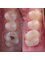 Dr. Moustafa Nashat - Caries removal followed by white composite filling 
