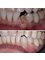 Dr. Moustafa Nashat - Caries removal followed by tooth build up 